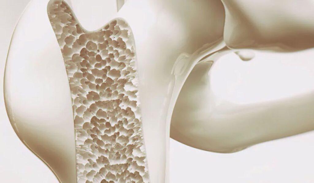 Osteoporosi