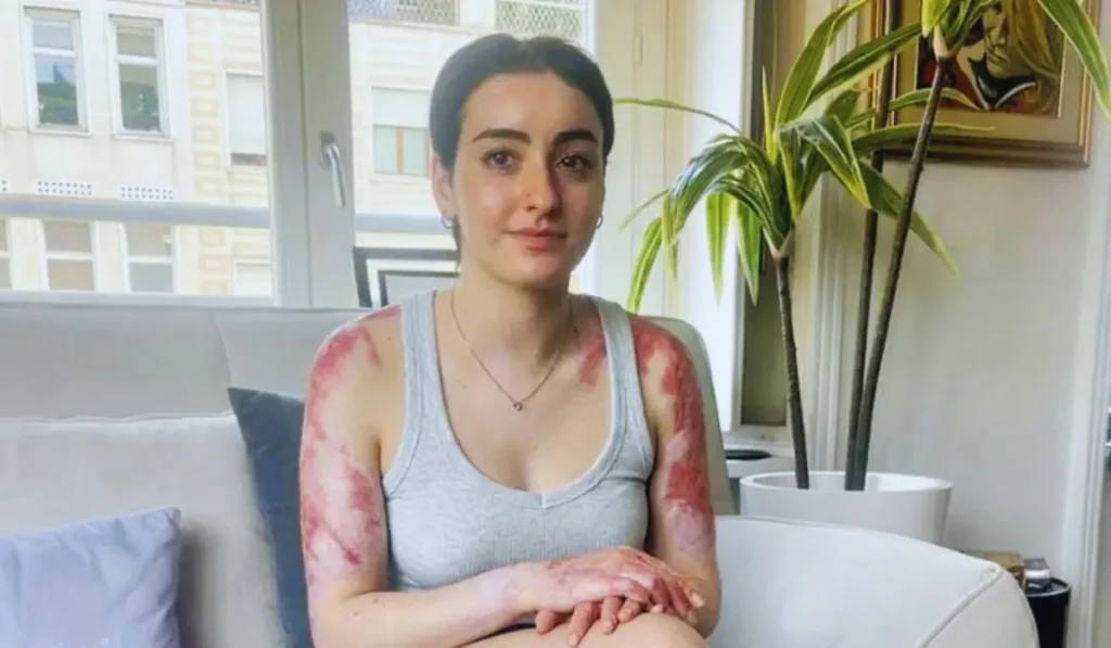 Sofia Donadio mostra le ustioni riportate nell’incendio del locale