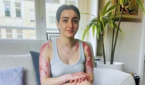 Sofia Donadio mostra le ustioni riportate nell’incendio del locale