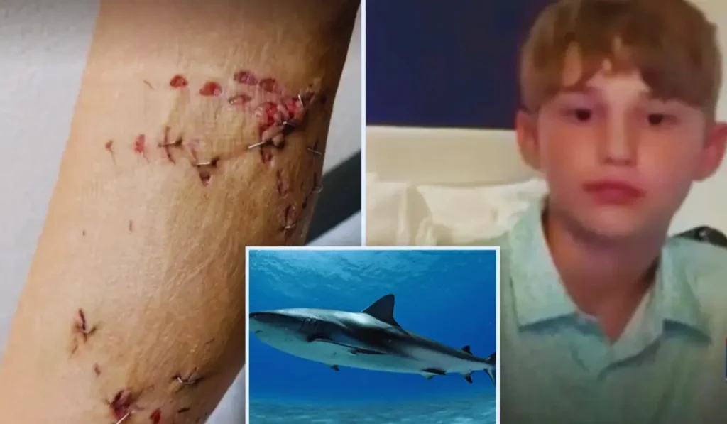 Bambino di 12 anni attaccato da squalo durante vacanza